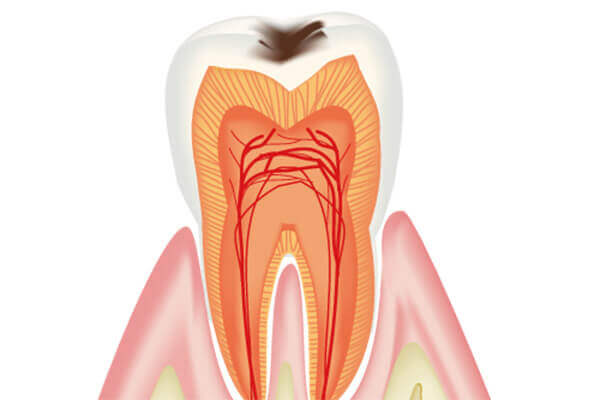 虫歯治療