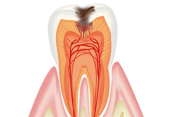虫歯治療