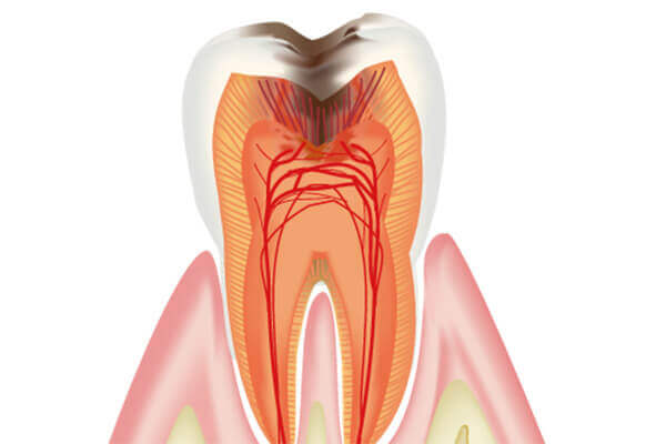 虫歯治療