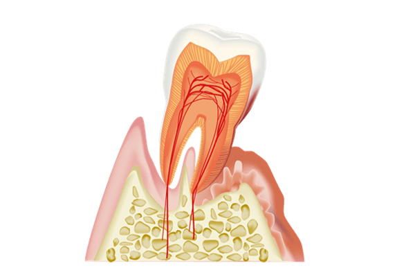 歯周病治療
