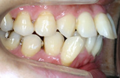 Case02 歯並びが凸凹で、口が閉じずらい 術前